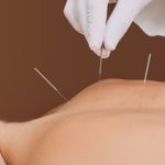 ¿Cómo son las agujas de acupuntura?