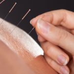 Técnicas de acupuntura: guía completa para entender sus bases